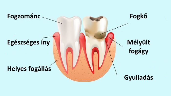 A fogíny egészsége - iSmile Dental Clinic